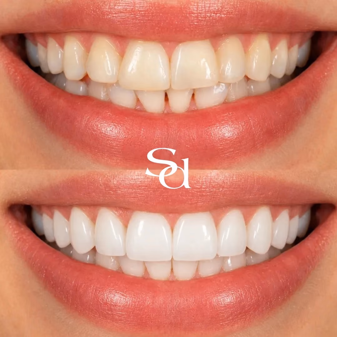 Composite bonding before and after at Sale Dental Spa: front teeth reshaped and evened out with composite bonding, by Dr Aisha Ahmed. Un-retouched.