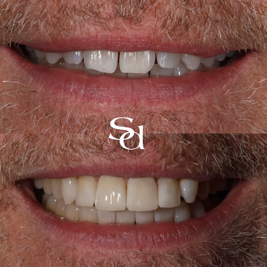 Clear aligners and composite bonding before and after at Sale Dental Spa: straightened and refined smile, by Dr Hamza Mirza. Un-retouched.
