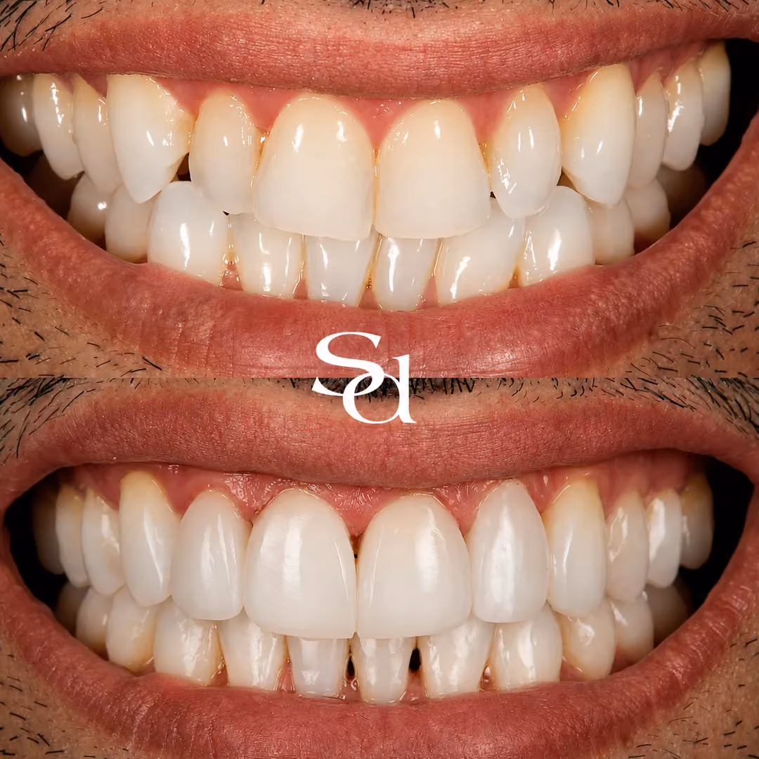Clear aligners and composite bonding before and after at Sale Dental Spa: crooked teeth aligned and finished with bonding, by Dr Hamza Mirza. Un-retouched.