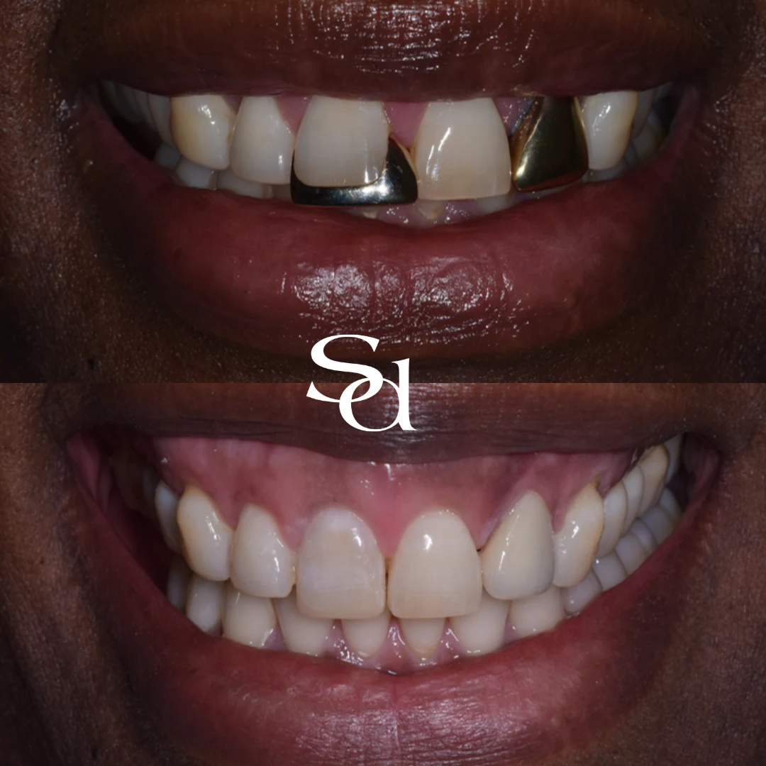 Invisalign and a crown before and after at Sale Dental Spa: gold teeth replaced and smile straightened with Invisalign and a crown, by Dr Aisha Ahmed. Un-retouched.