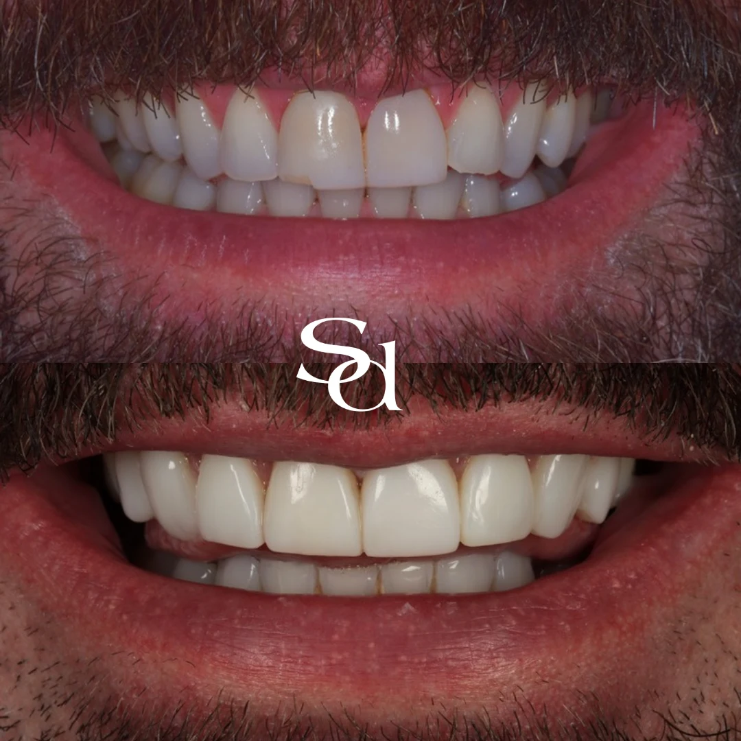 Composite bonding and whitening before and after at Sale Dental Spa: worn front teeth rebuilt with composite bonding and whitening, by Dr Aisha Ahmed. Un-retouched.