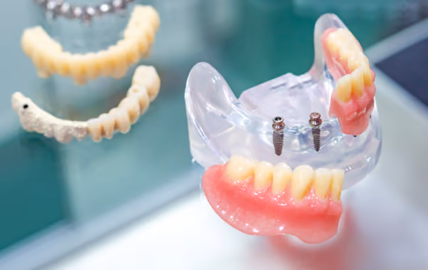 Mini implants