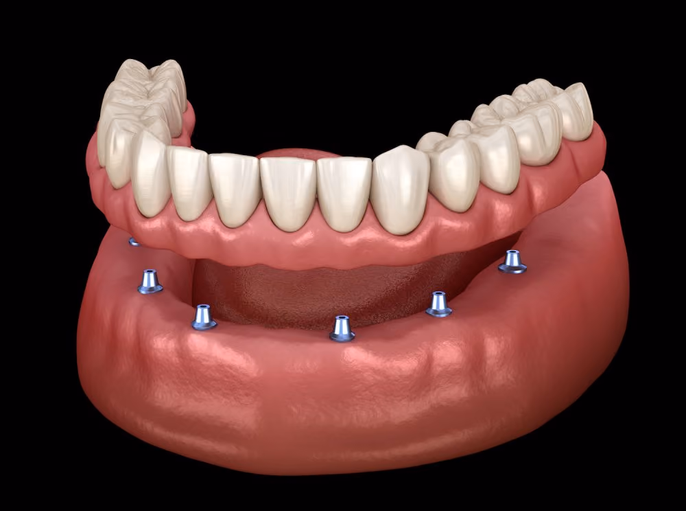 All-on-X vs. Traditional Dentures: A Complete Comparison