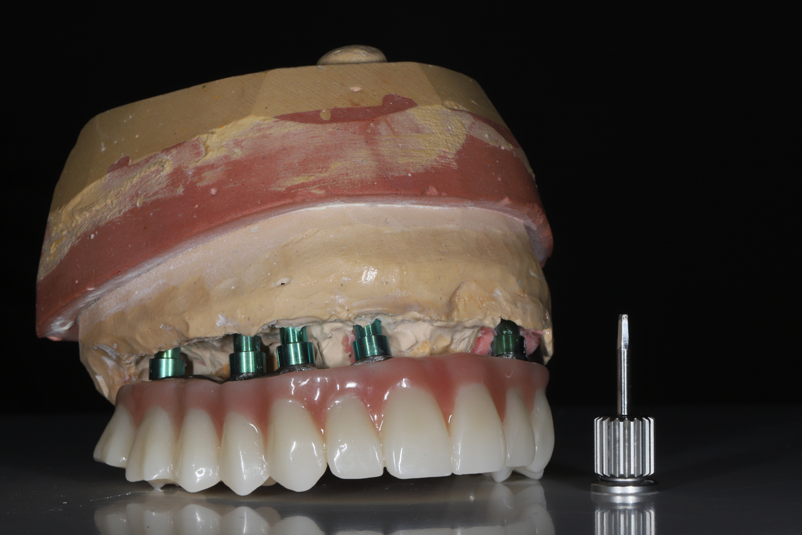 What Are All-on-X Dental Implants and How Do They Work?