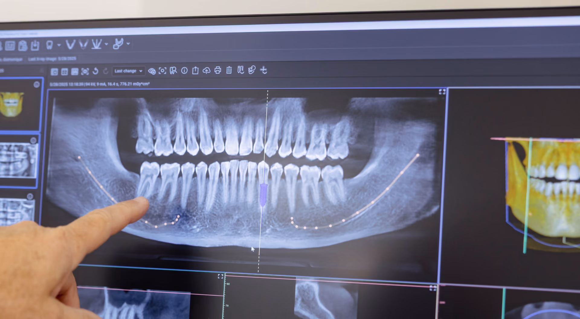 Close-up of a dental panoramic X-ray on a computer screen showing upper and lower teeth, with a hand pointing at the lower left molars.