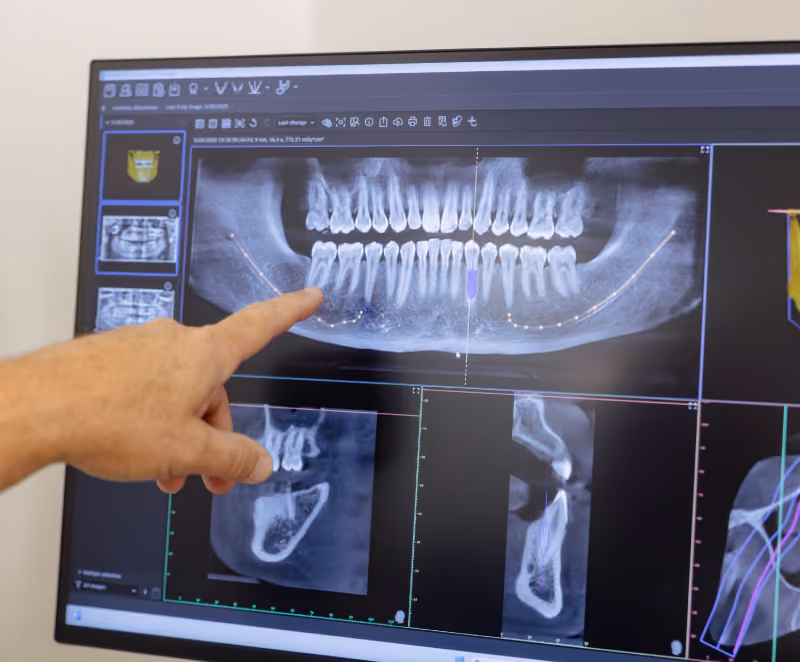A hand pointing at a digital panoramic dental X-ray displayed on a computer screen, showing teeth, jawbone structures, and detailed images of the lower jaw.