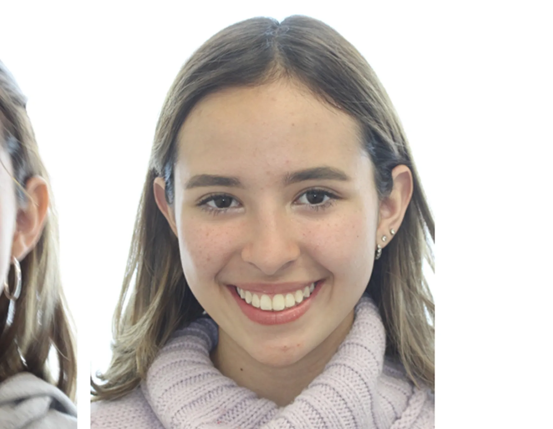 After orthodontic treatment at Cardall Orthodontics