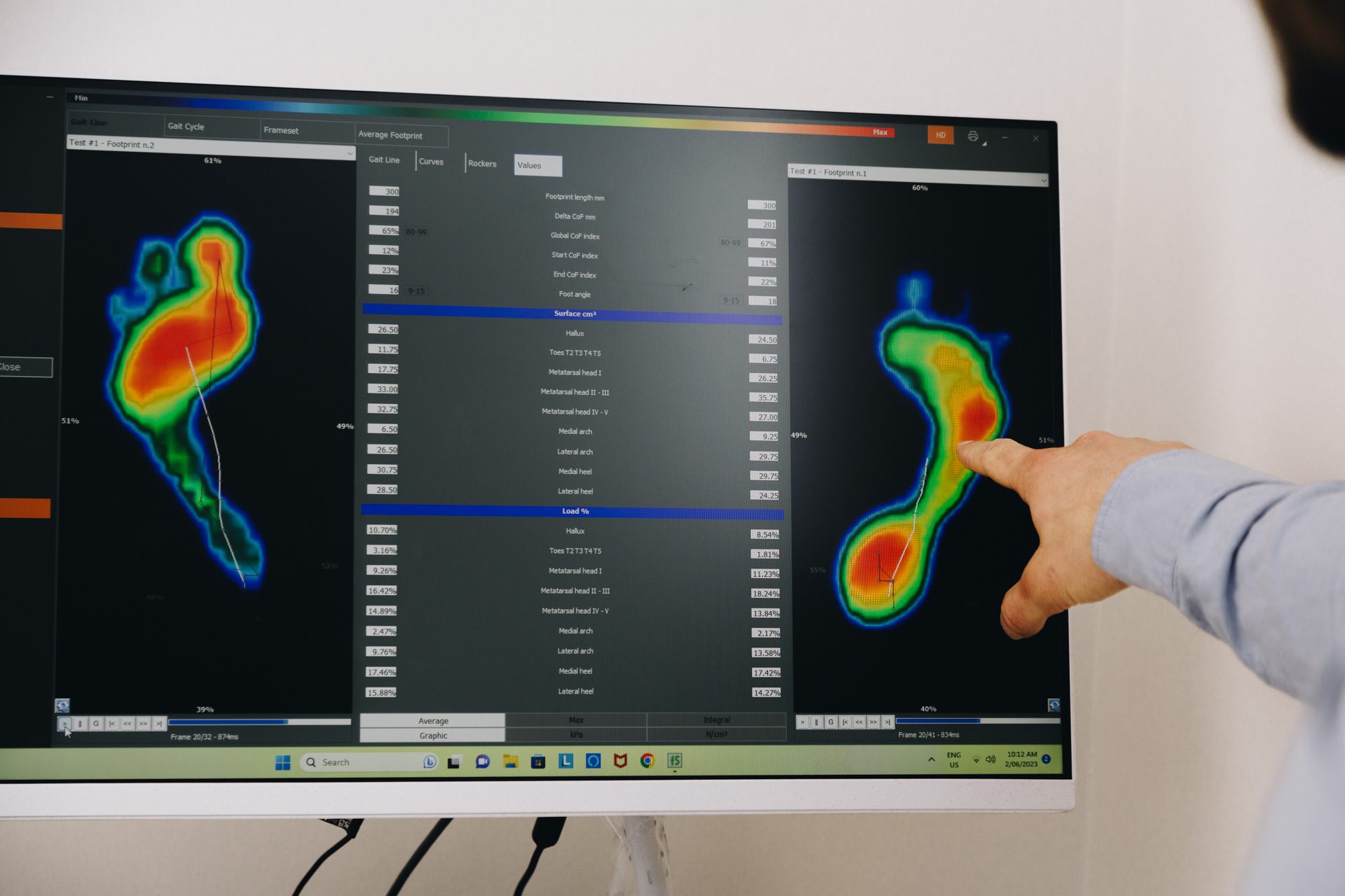 Foot pressure distribution and gait line data used in podiatry assessment