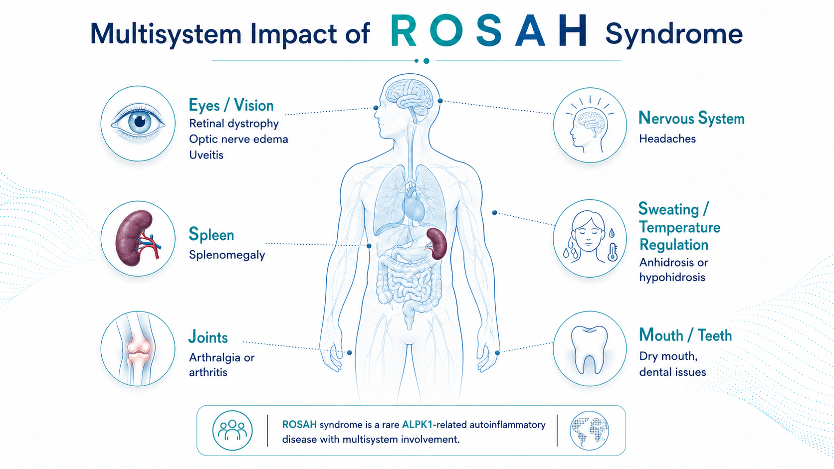 Infographic: multisystem impact of ROSAH syndrome — eyes and vision (retinal dystrophy, optic nerve edema, uveitis), nervous system (headaches), spleen (splenomegaly), sweating and temperature regulation (anhidrosis or hypohidrosis), joints (arthralgia or arthritis), and mouth and teeth (dry mouth, dental issues)