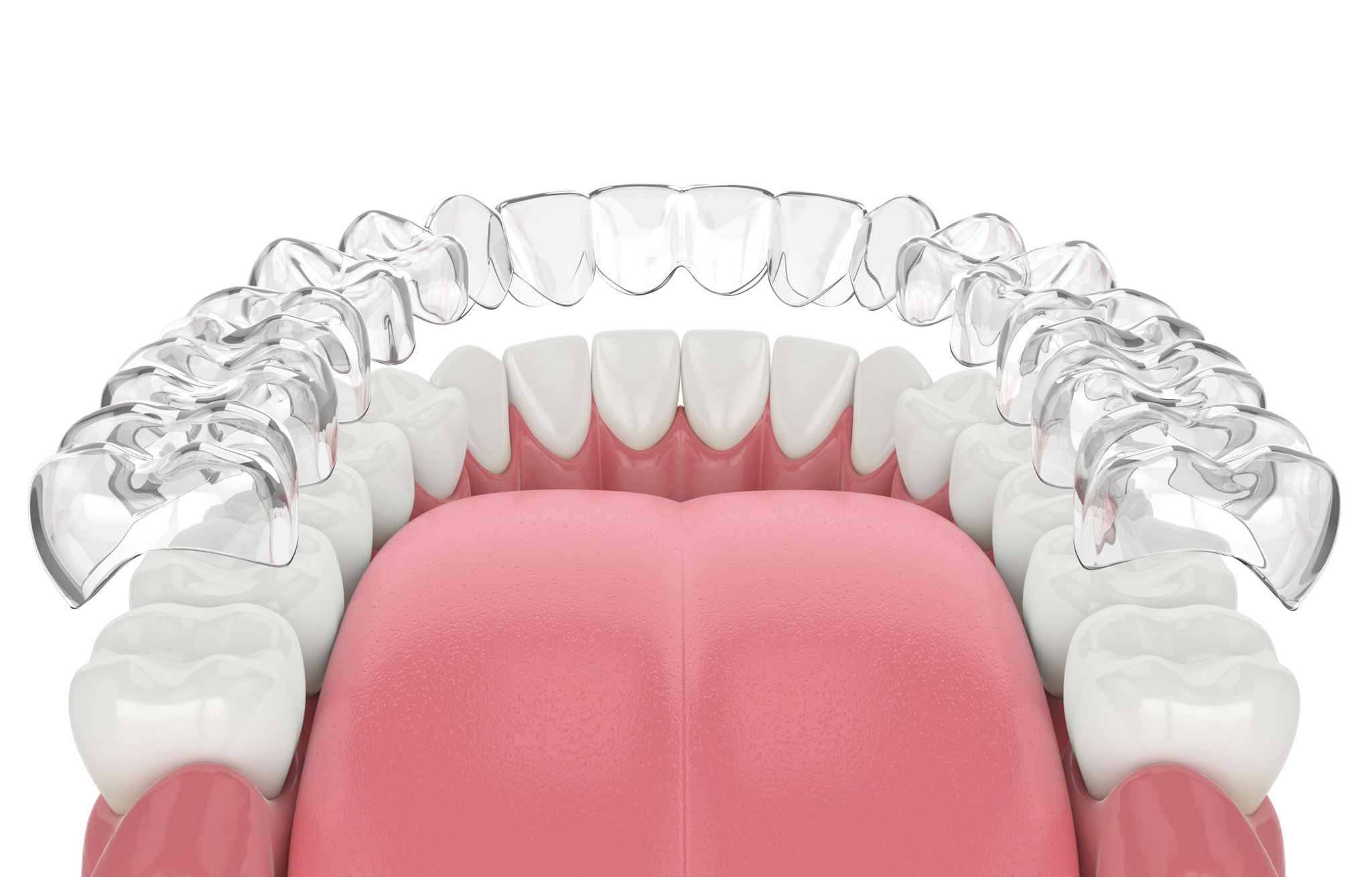 Invisalign clear aligner being placed over teeth at Pair & Hoang Orthodontics
