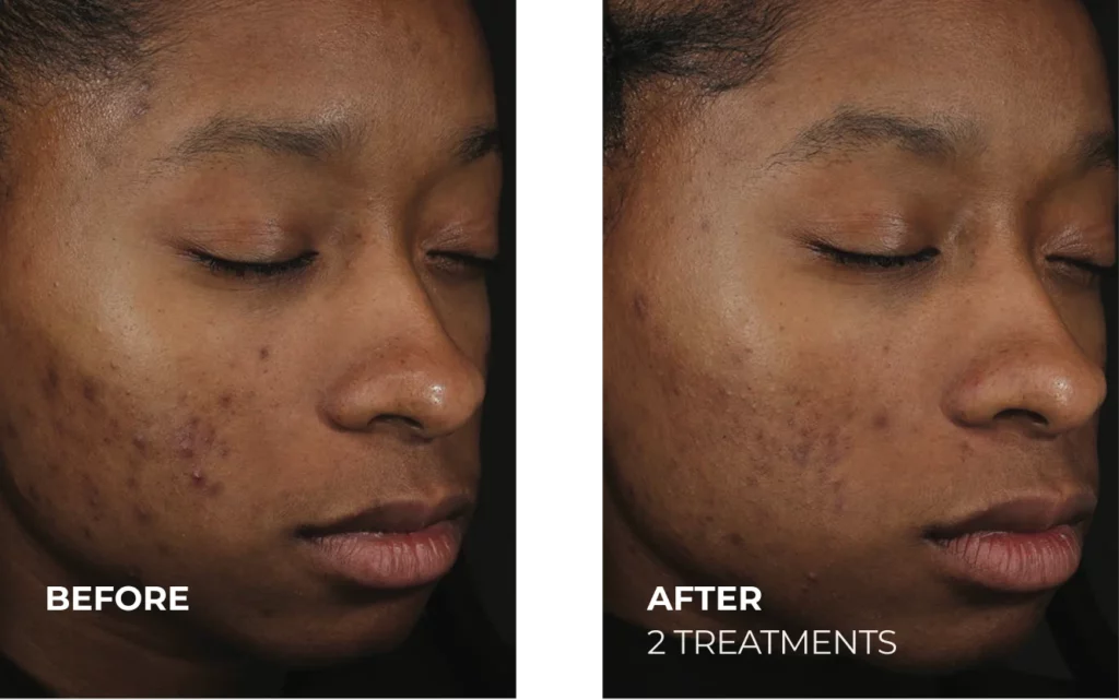 DiamondGlow® before and after