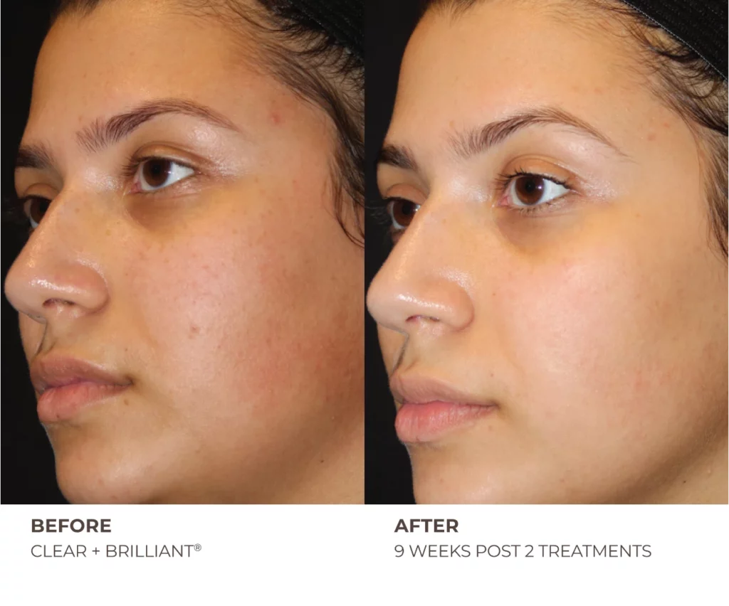 Clear + Brilliant Before and After
