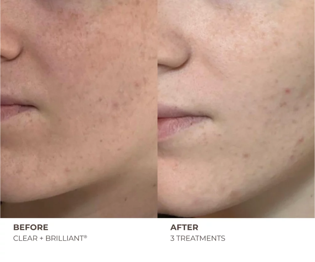 Clear + Brilliant Before and After