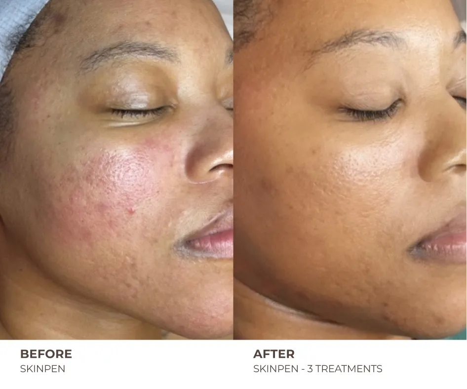 microneedling for scars
