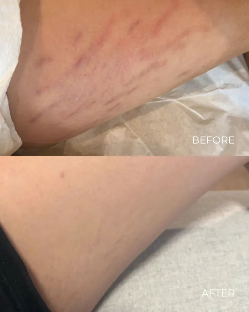 Microneedling for Stretch Marks