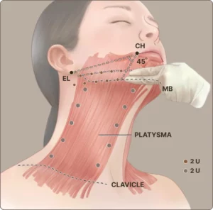 Nefertiti Lift Injection Points