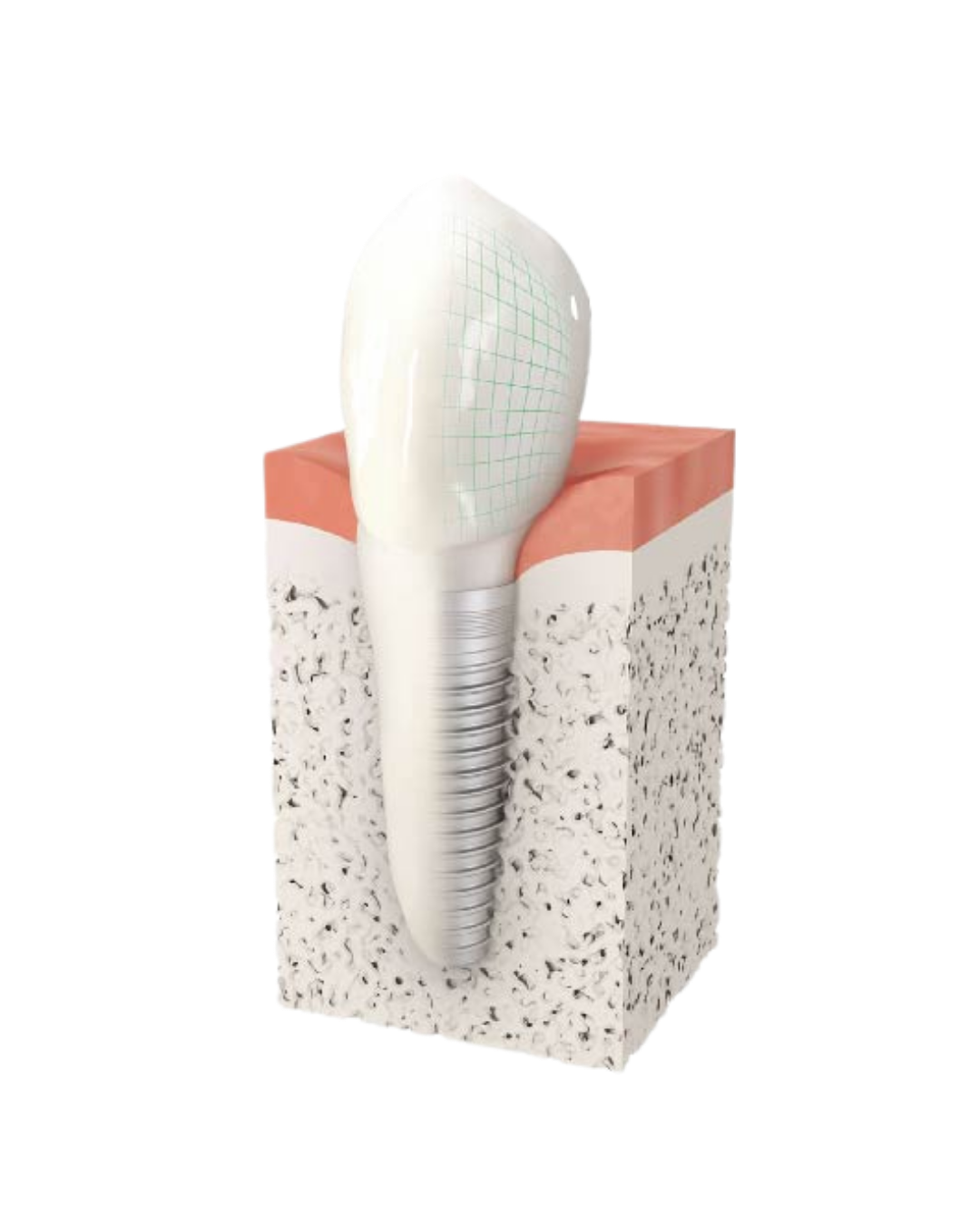 Illustration d'un implant dentaire : vis en titane fixée dans l'os de la mâchoire et surmontée d'une couronne