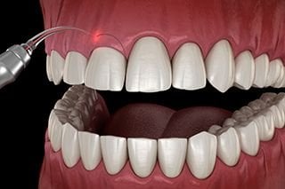 Dental laser reshaping the gumline