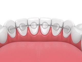 bonded retainer