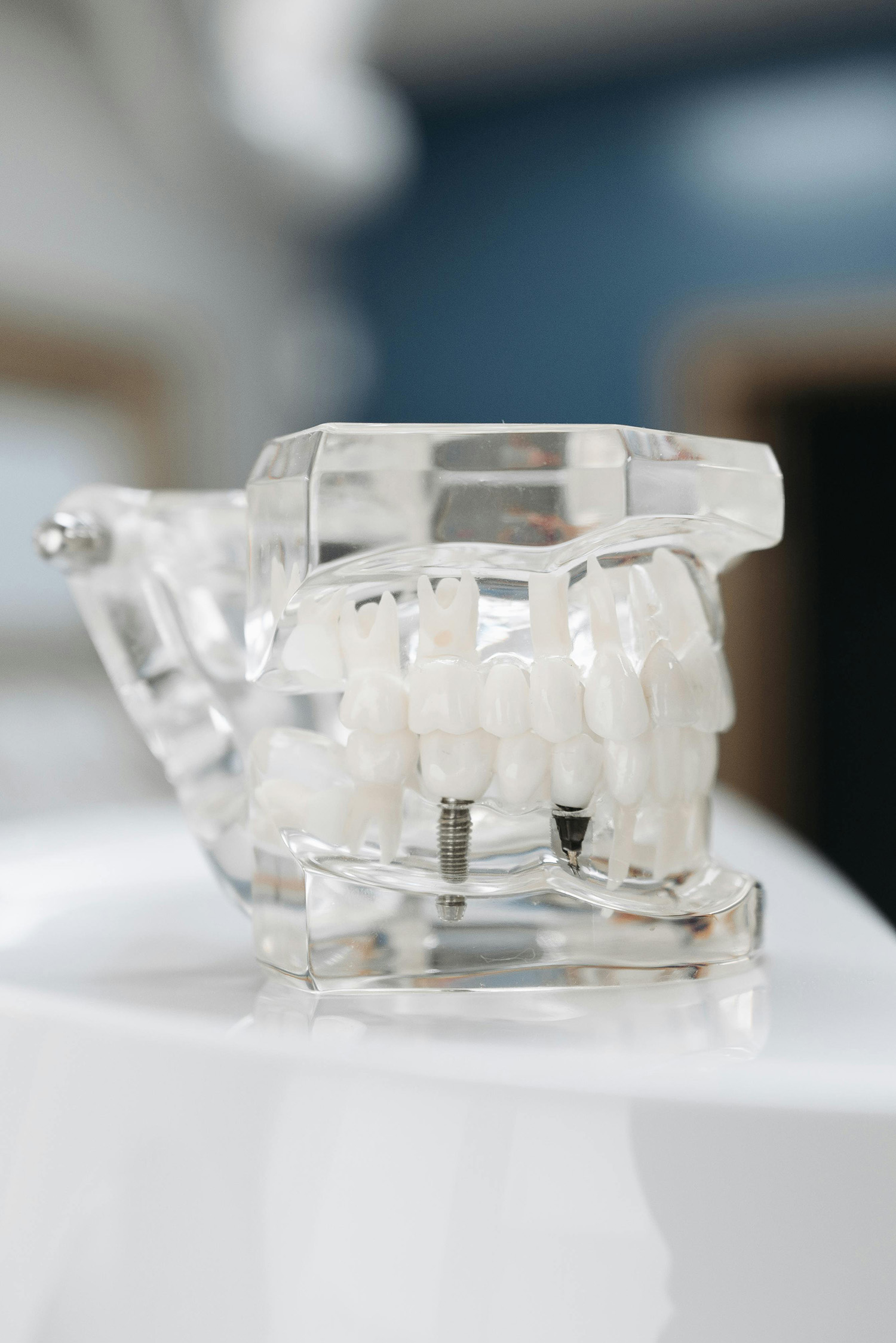 Clear model of a dental implant embedded in a jaw with teeth