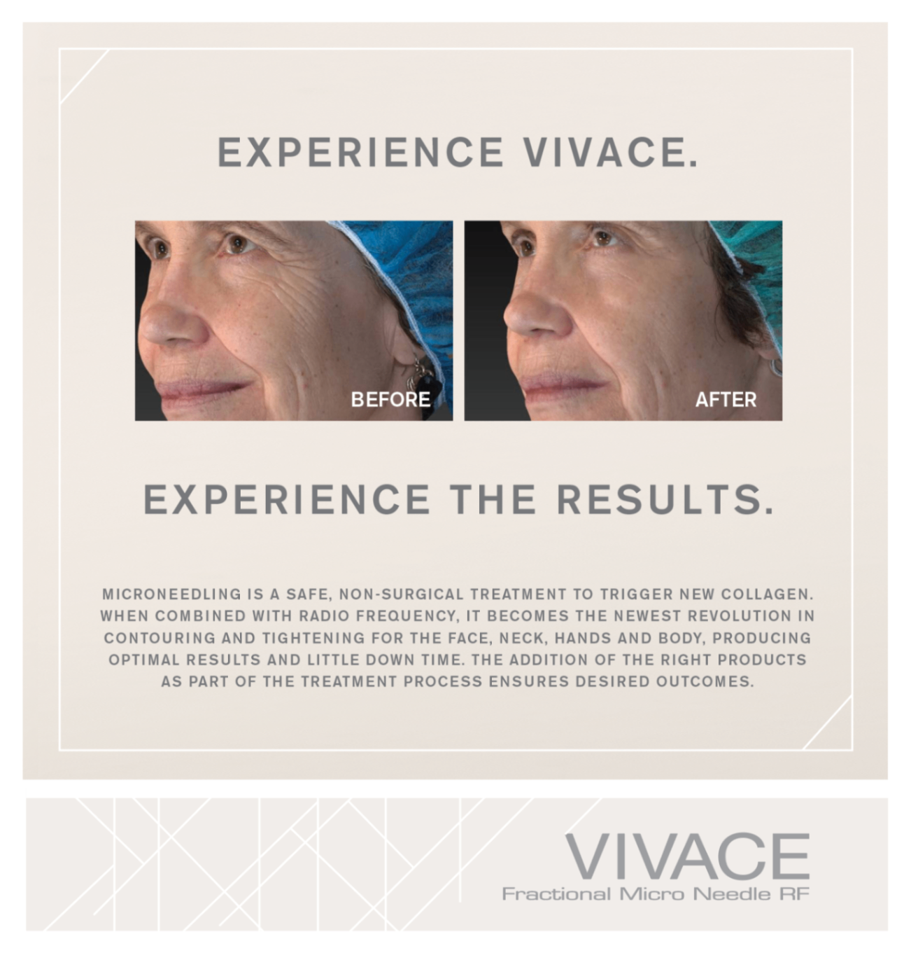 Before-and-after facial volume and skin firmness comparison