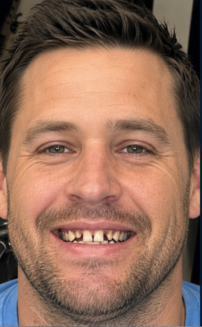Patient before dental treatment at C. Patrick Gray, DDS. in Flint, MI, showing a visible gap between upper front teeth