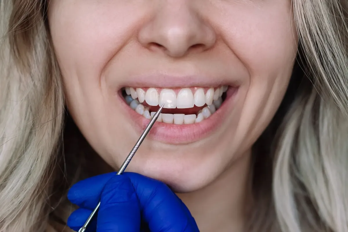 Close-up of a smiling woman receiving a dental examination, with a dentist’s blue-gloved hand using an oral probe to inspect her teeth.