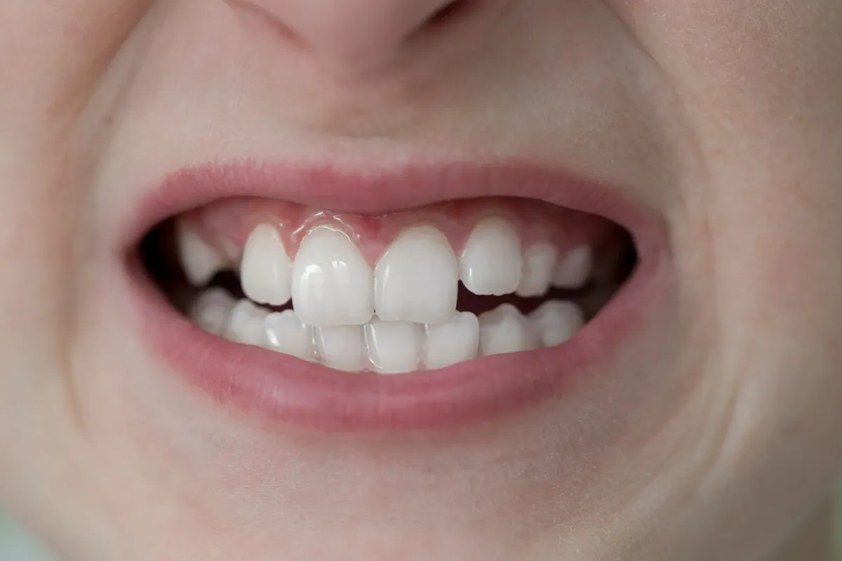 Close-up of a smiling mouth with white, slightly misaligned teeth, visible gums, and pink lips, conveying a friendly, natural expression.