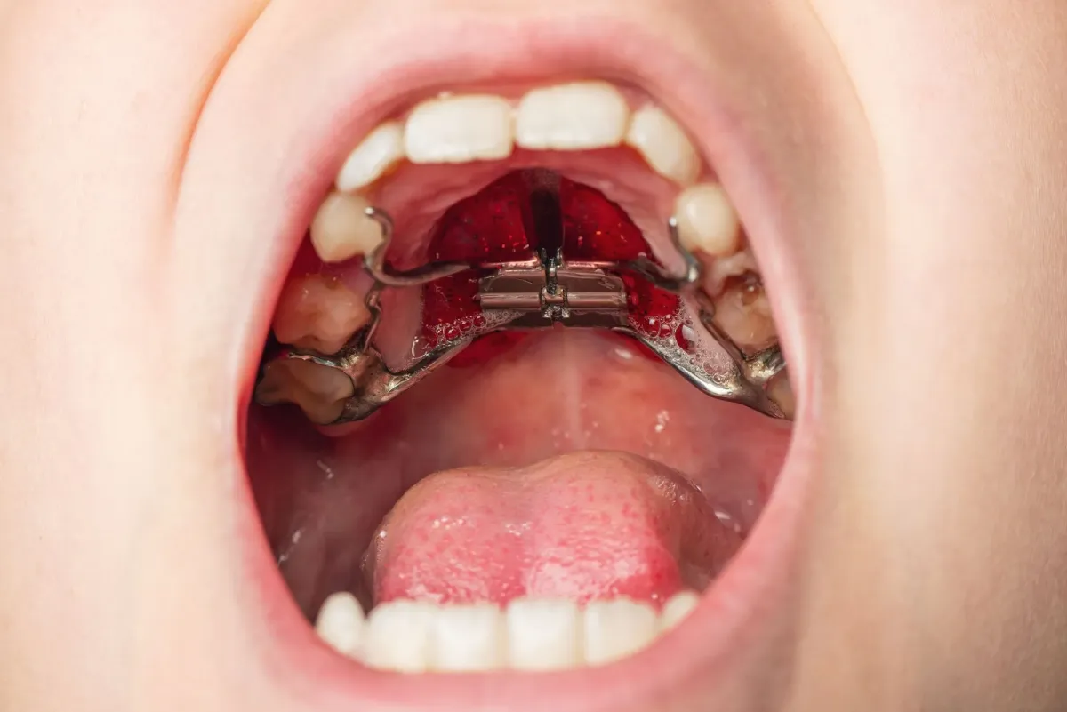 Close-up of an open mouth showing a metal orthodontic palatal expander attached to the upper teeth, with tongue and gums visible.