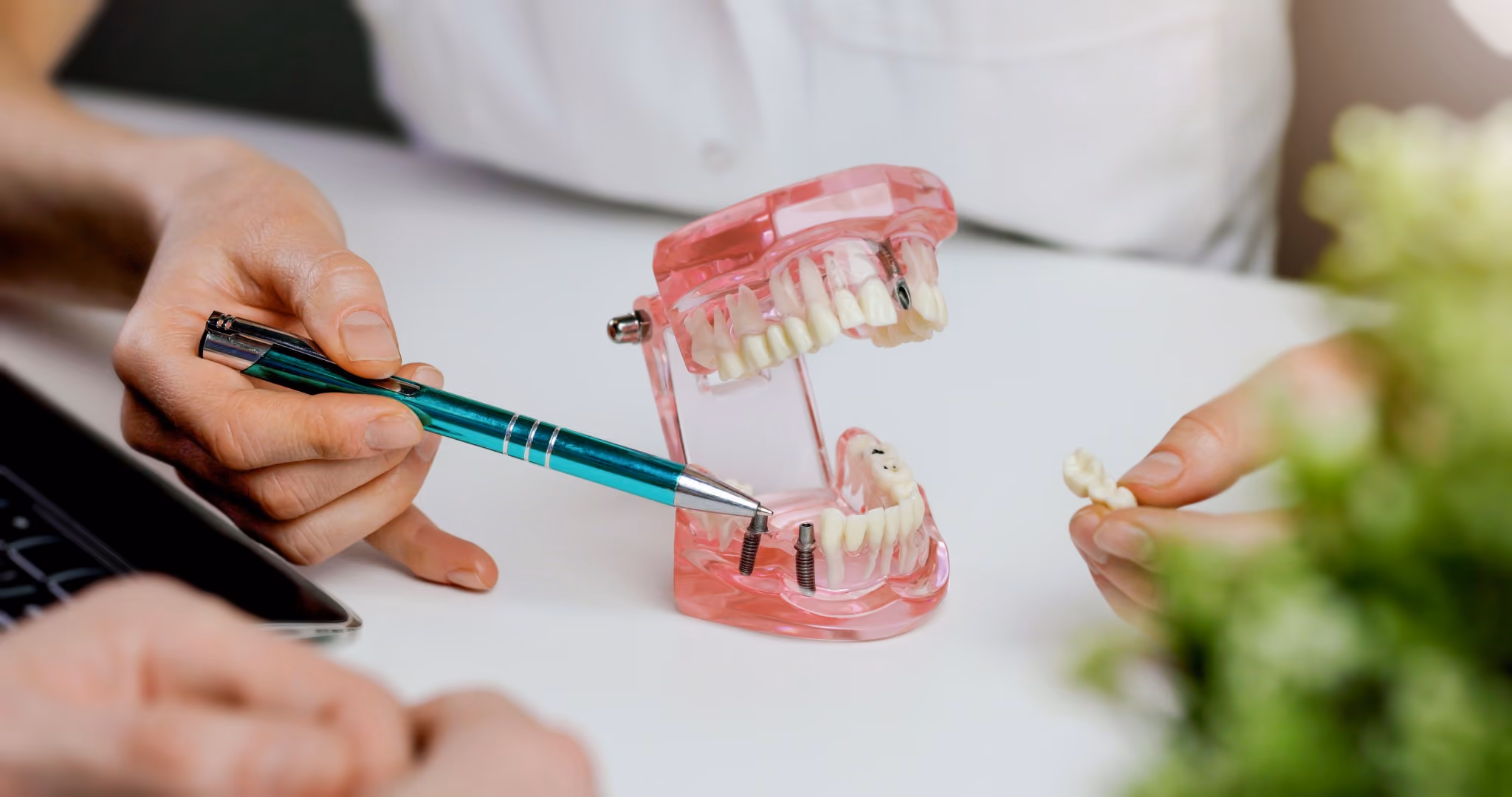 Dental Implants