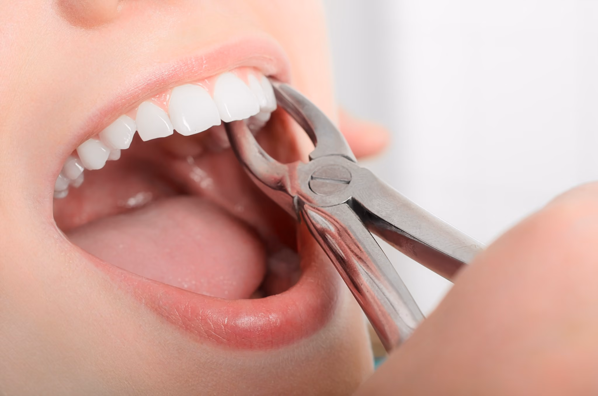 Tooth Extractions