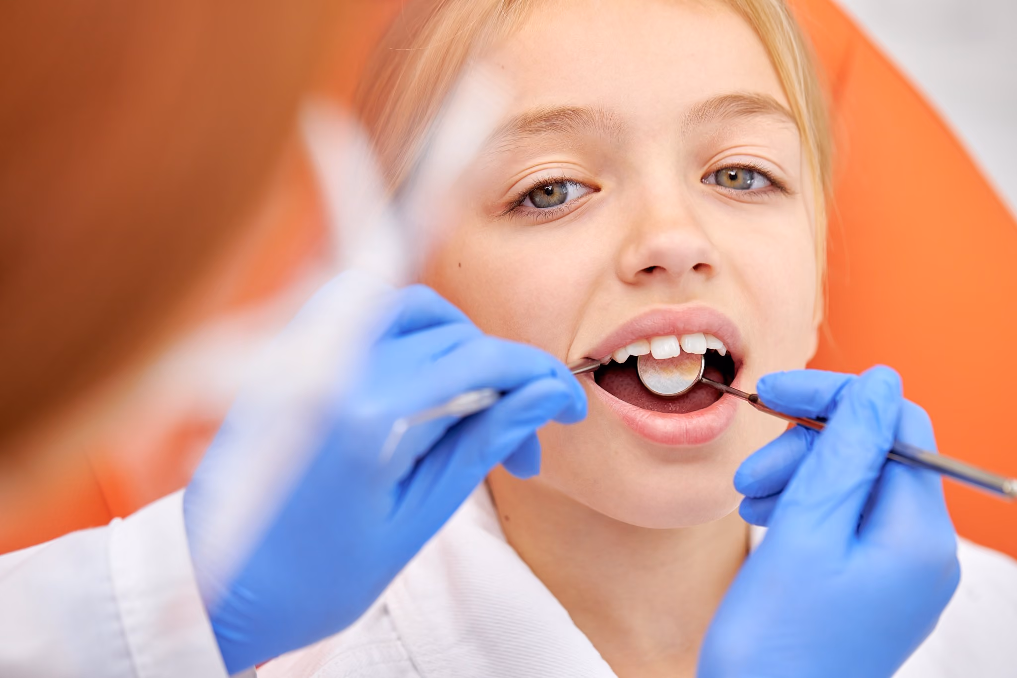 Dental Sealants