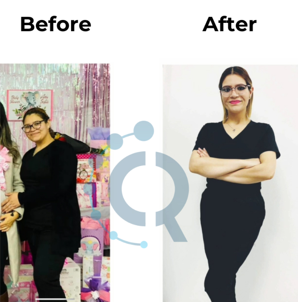 facelift before and after tijuana