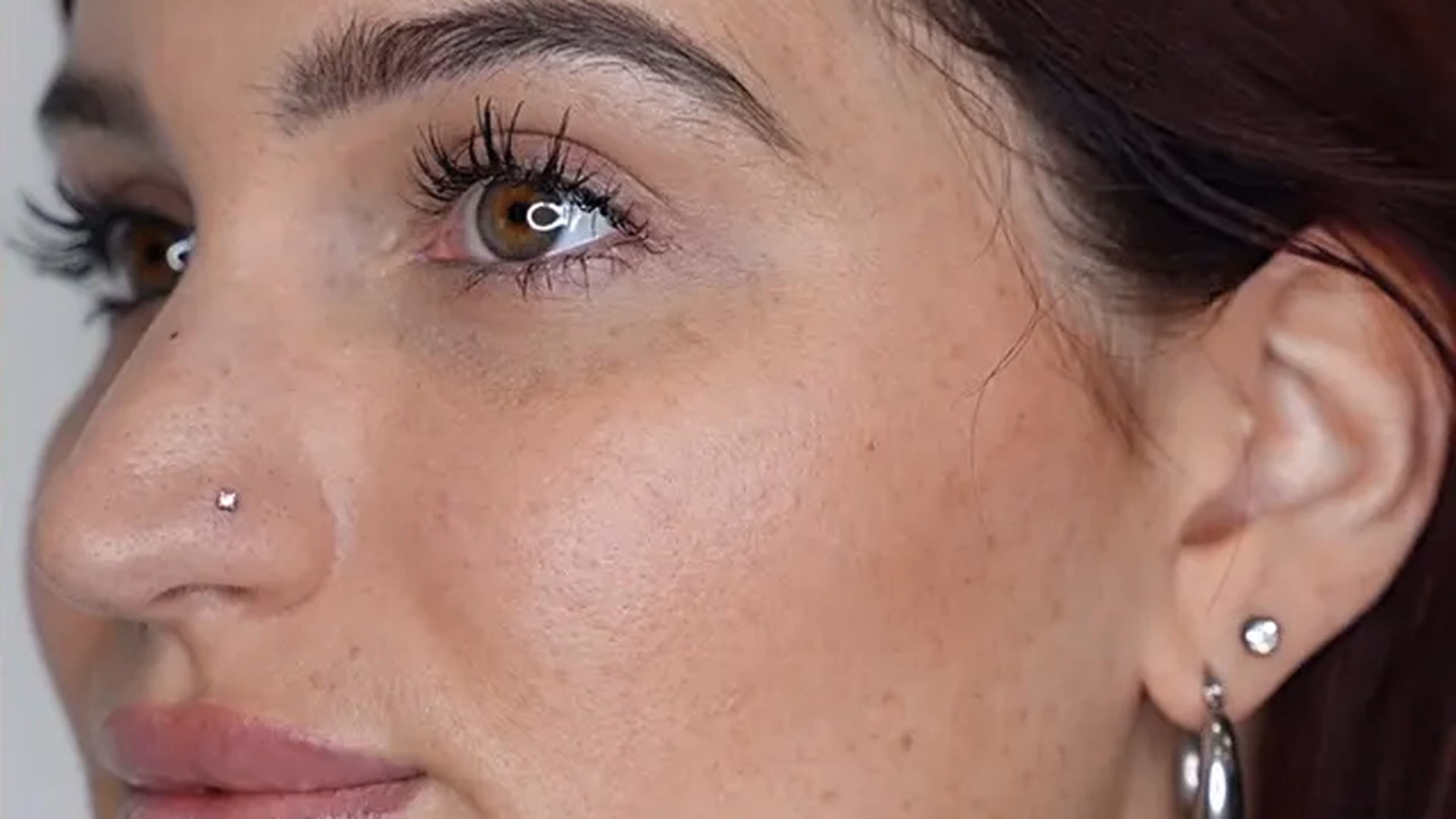Facial balancing after photo, one treatment, at VIV Wellness Dallas