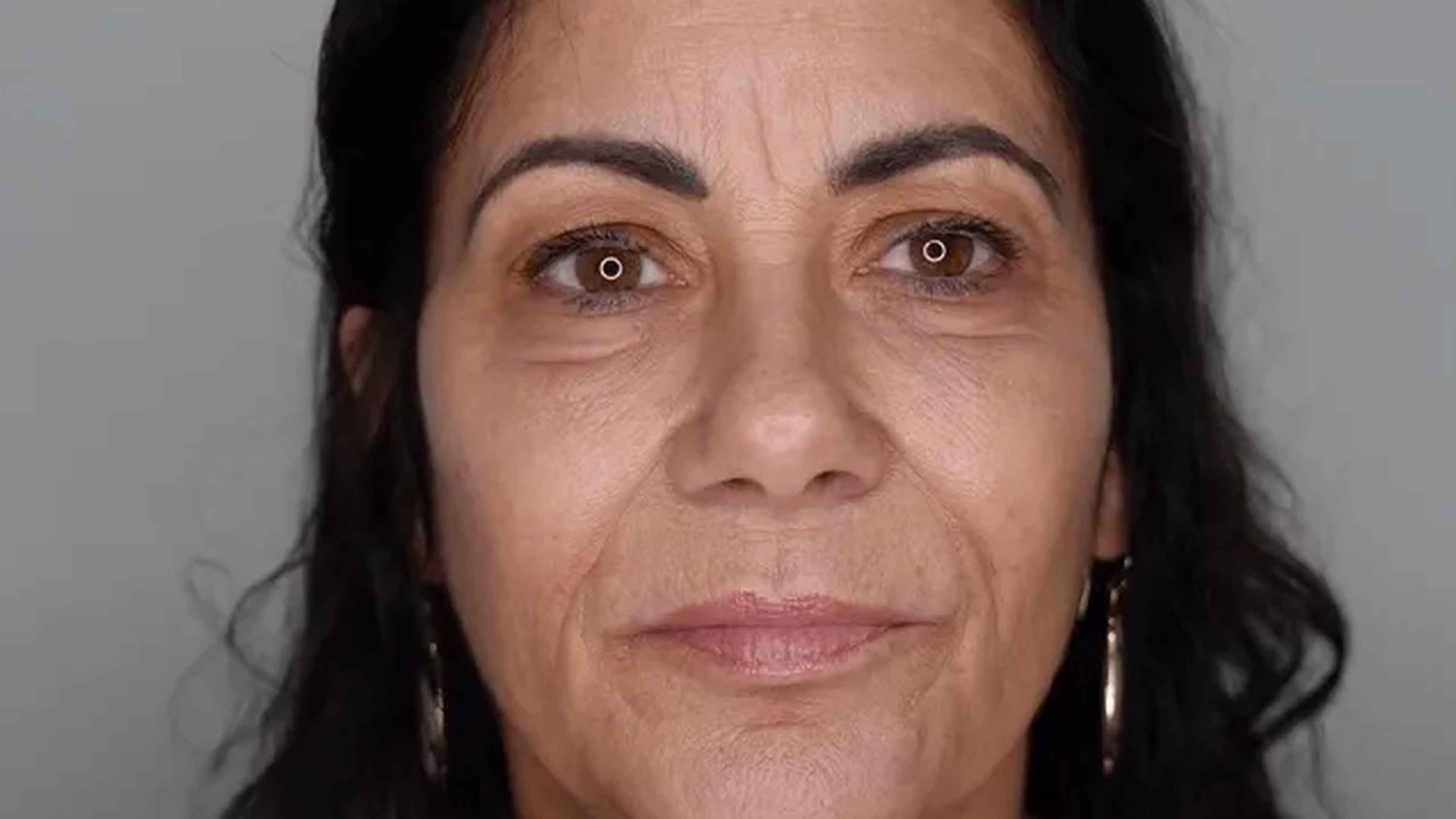 Facial rejuvenation before photo of a VIV Wellness patient in Dallas