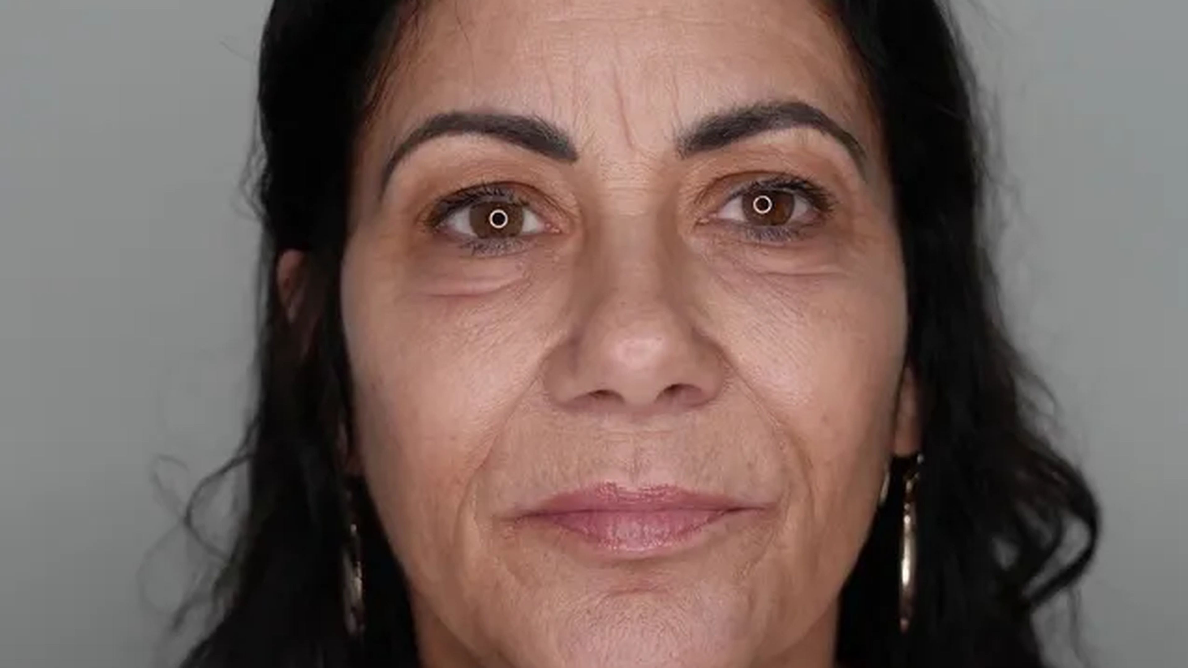 Facial rejuvenation before photo of a VIV Wellness patient in Dallas
