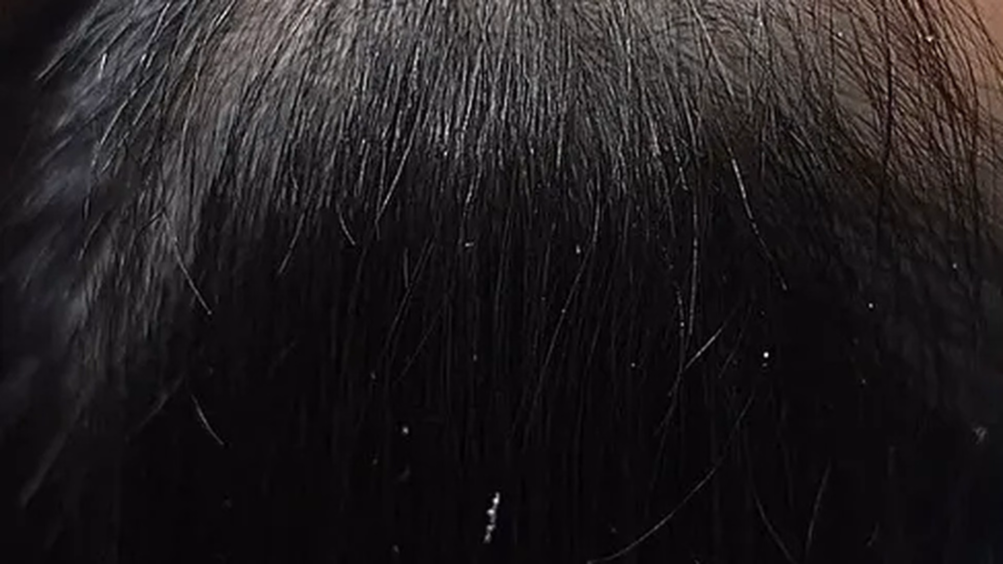Hair restoration before photo of a VIV Wellness patient in Dallas