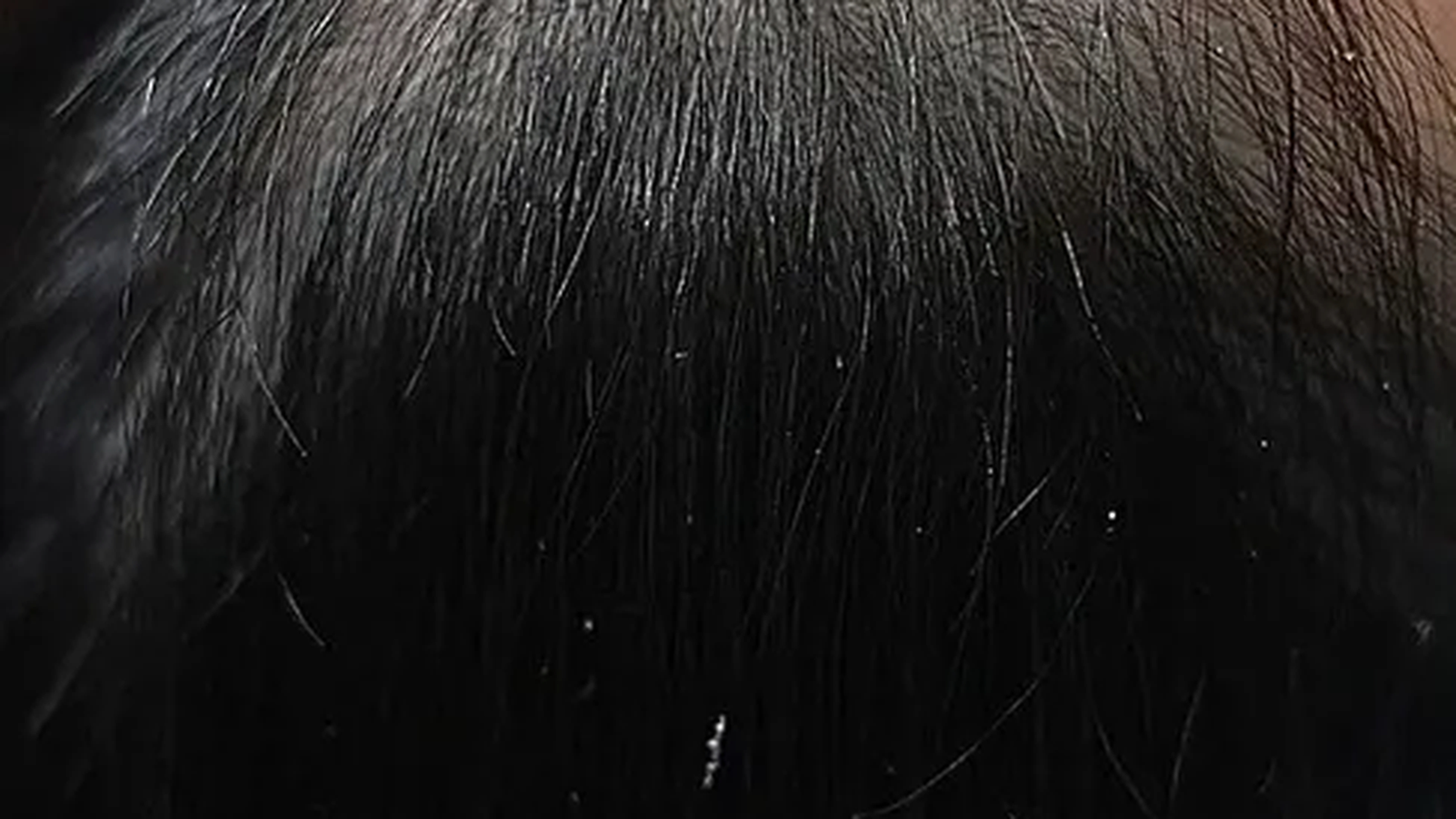 Hair restoration before photo of a VIV Wellness patient in Dallas