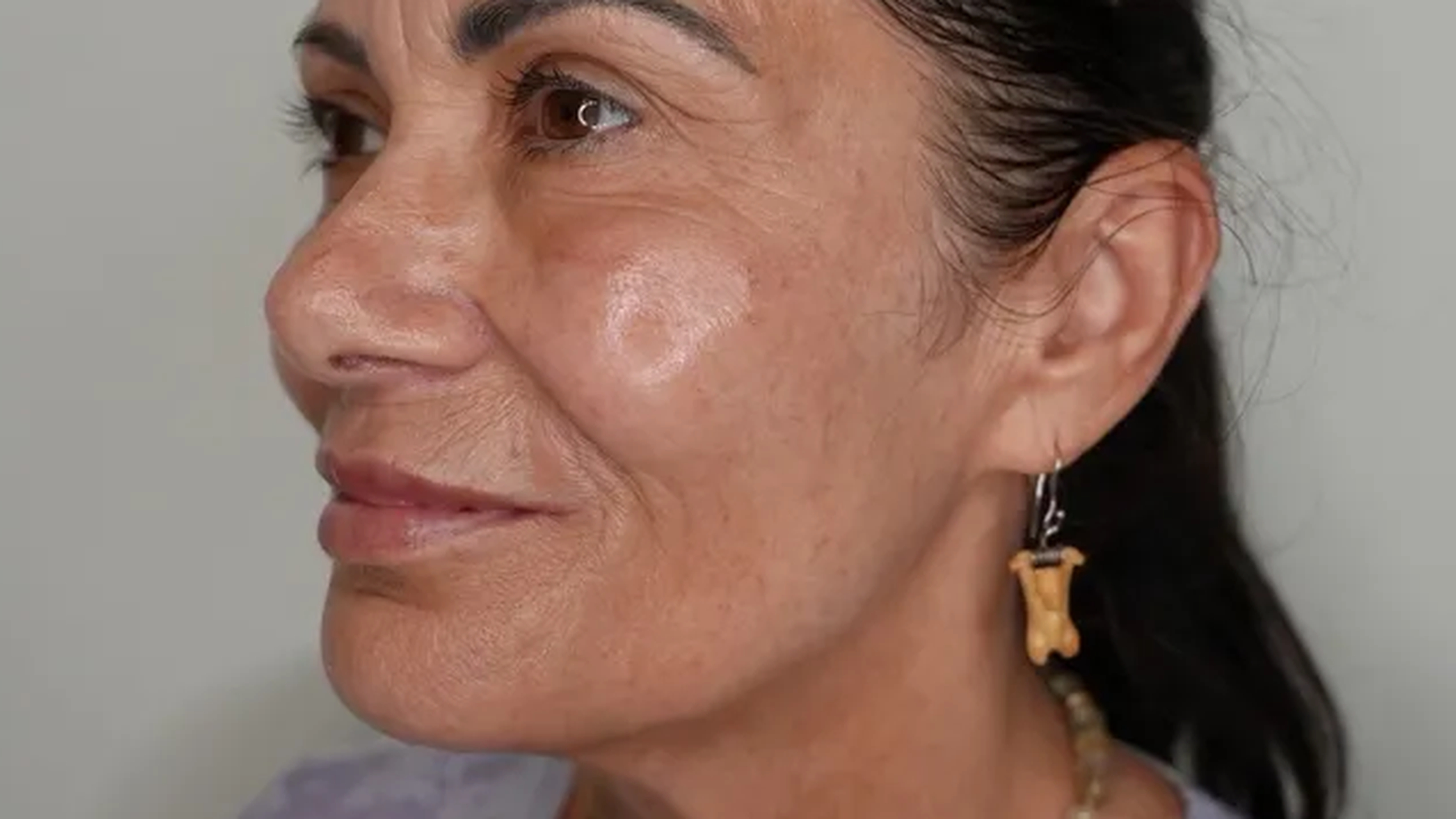 Facial rejuvenation after photo, one treatment, at VIV Wellness Dallas