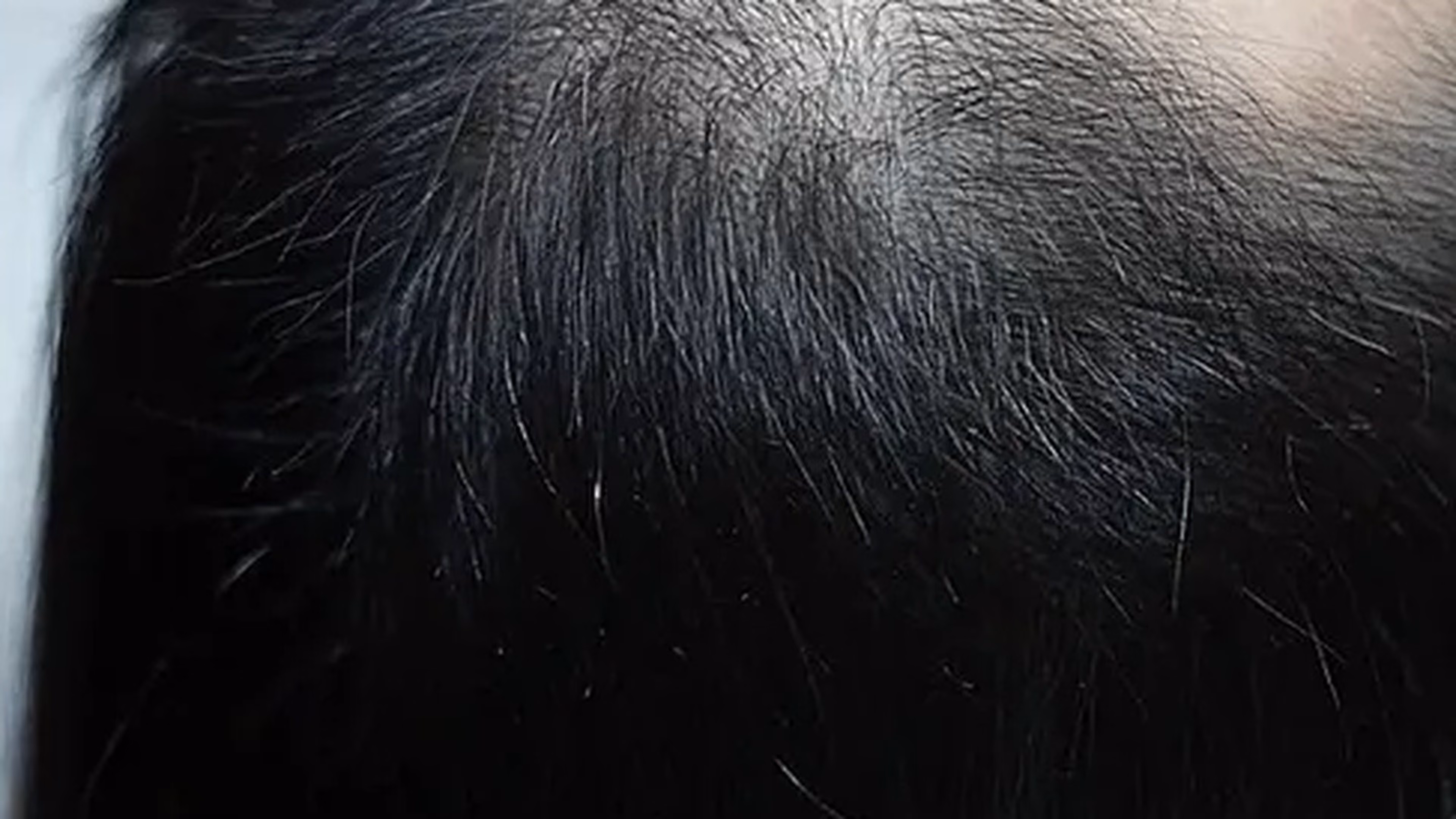 Hair restoration after photo, multiple treatments, at VIV Wellness Dallas