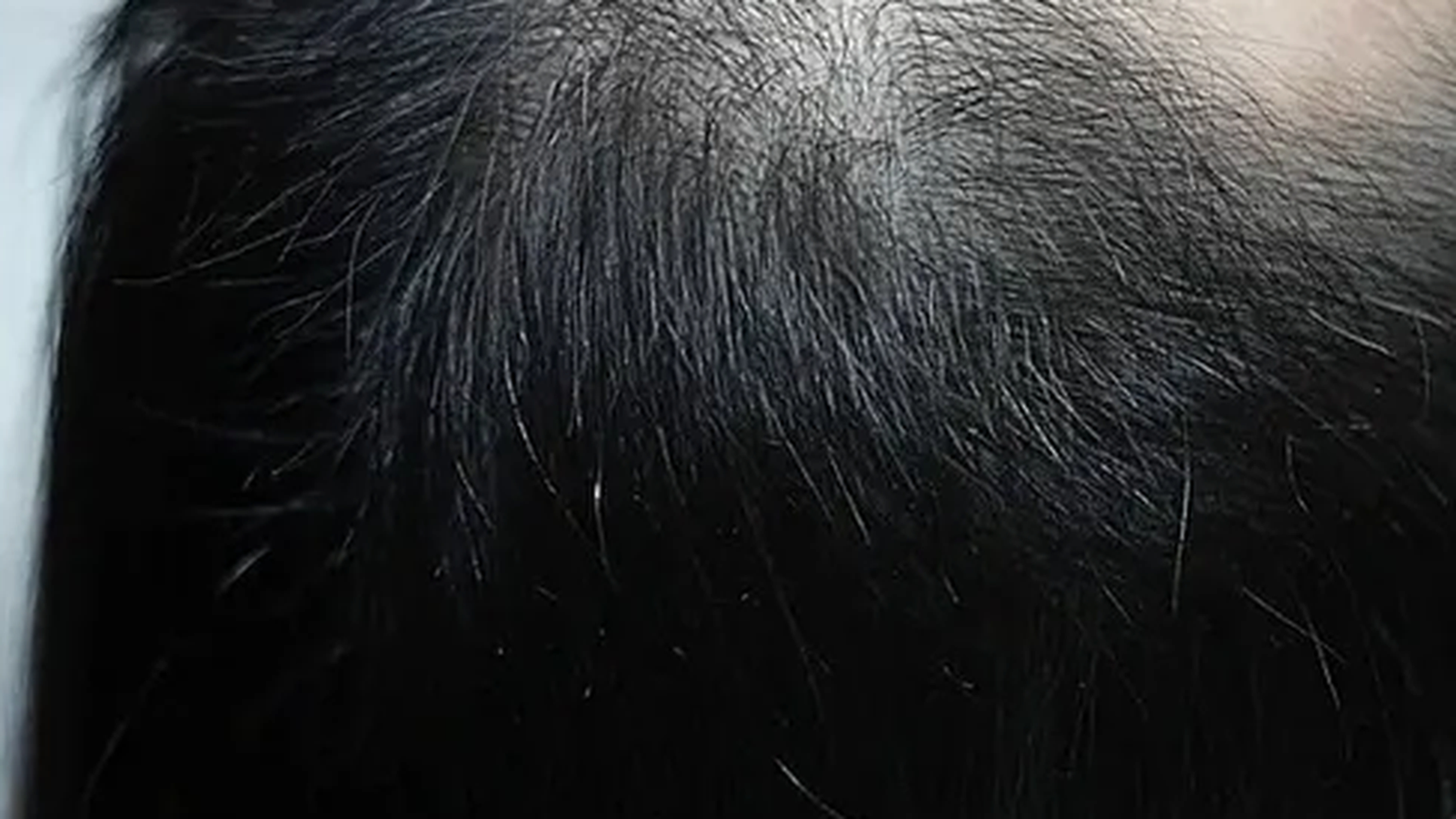 Hair restoration after photo, multiple treatments, at VIV Wellness Dallas