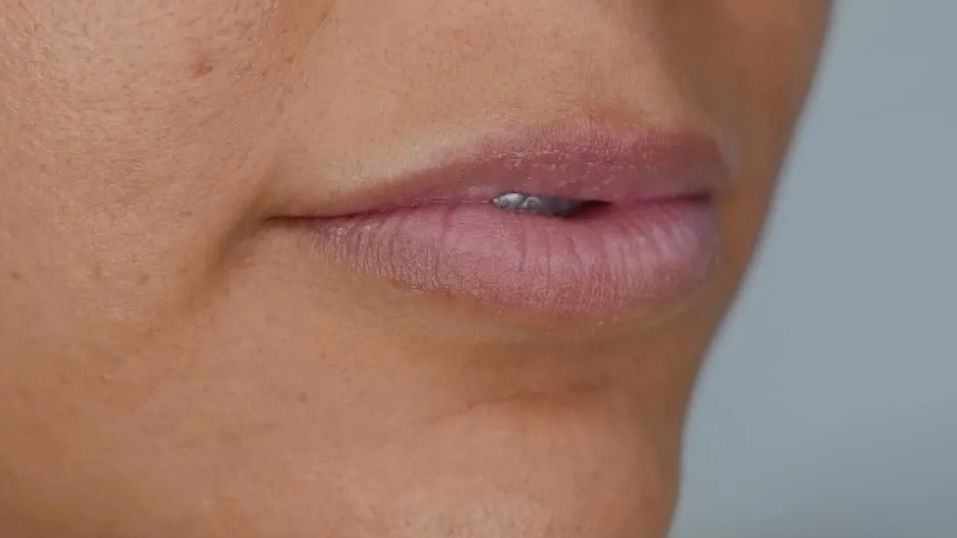 Lip filler before treatment at VIV Wellness Dallas