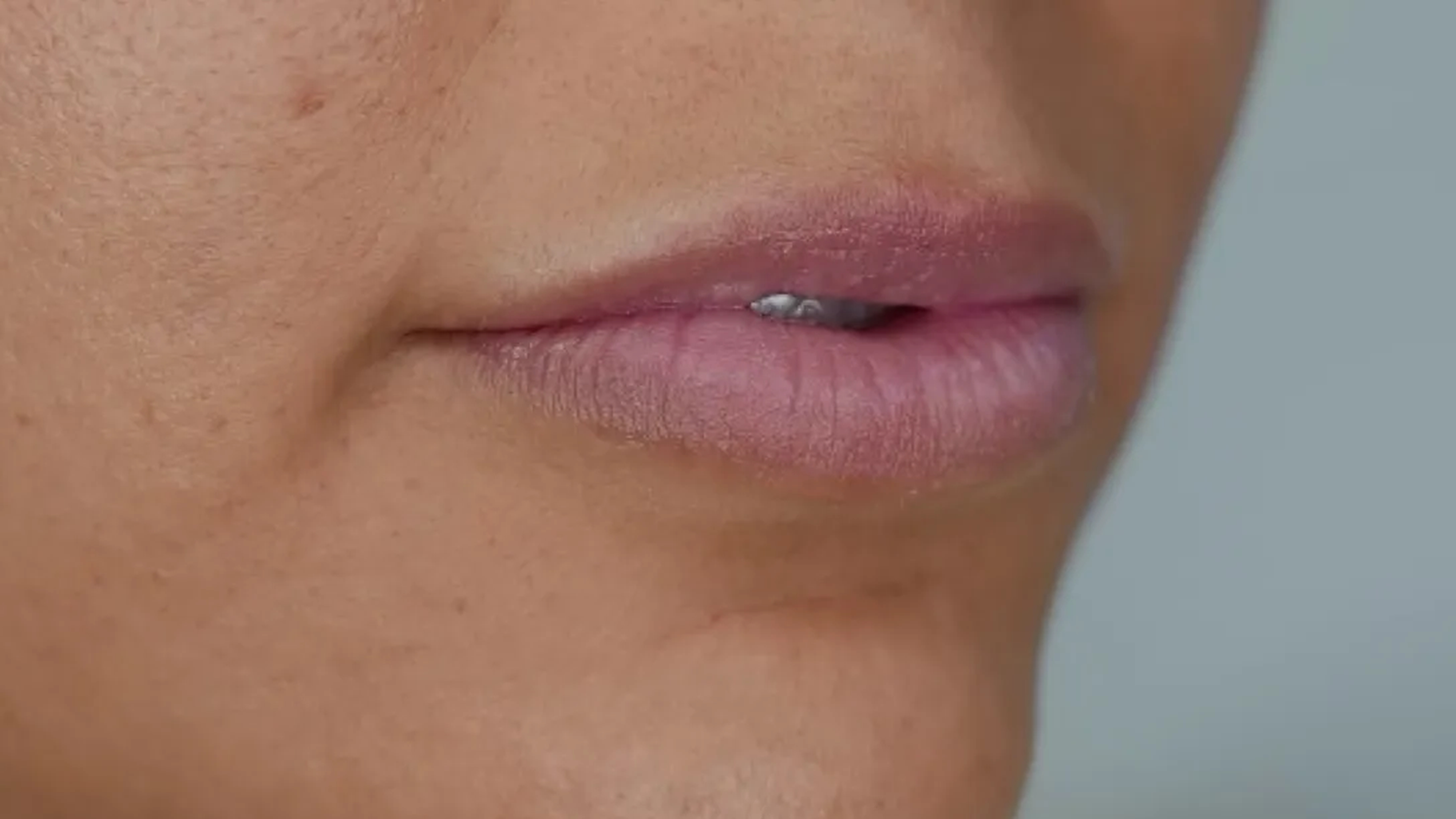 Lip filler before treatment at VIV Wellness Dallas