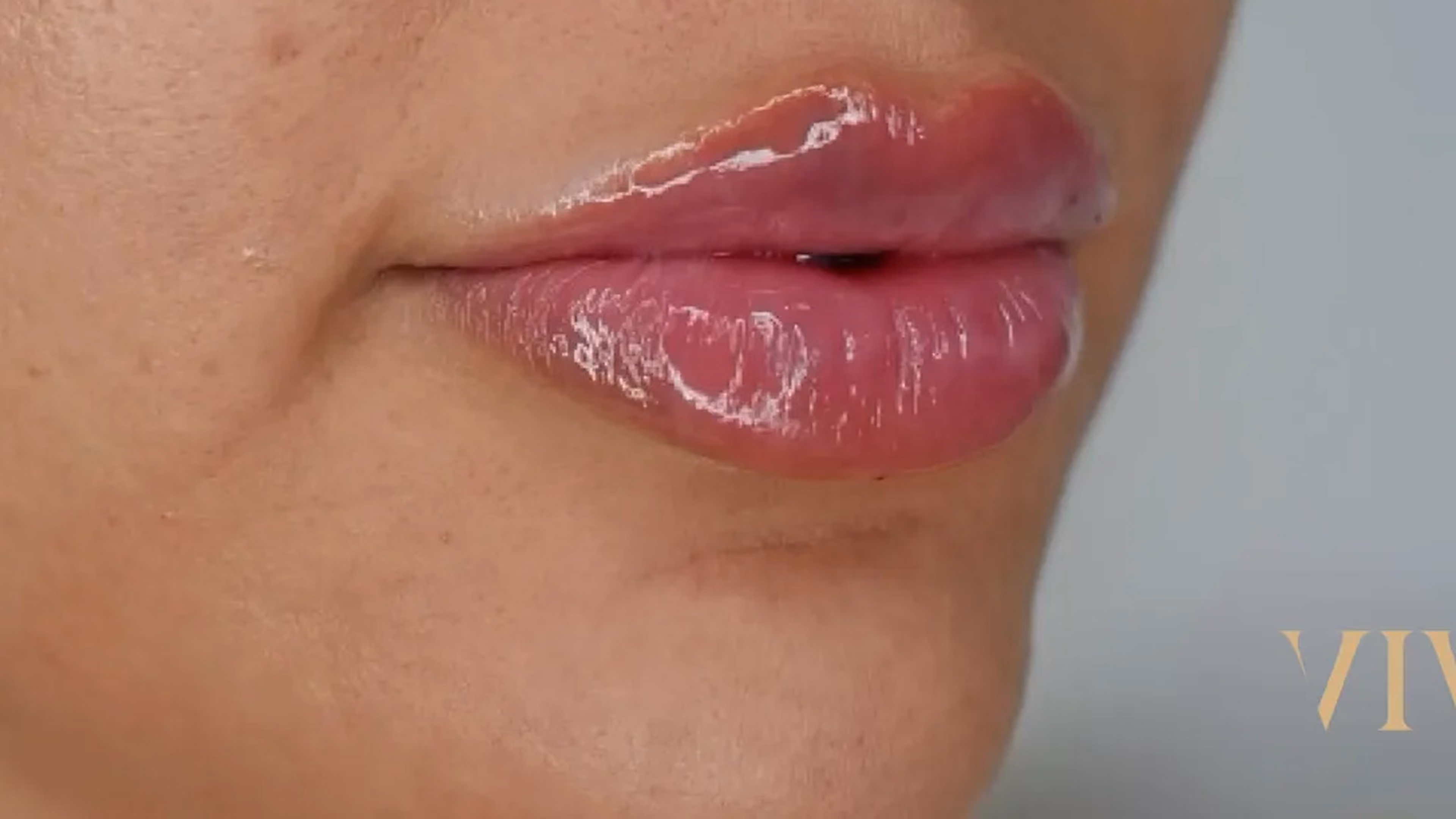 Lip filler after treatment at VIV Wellness Dallas