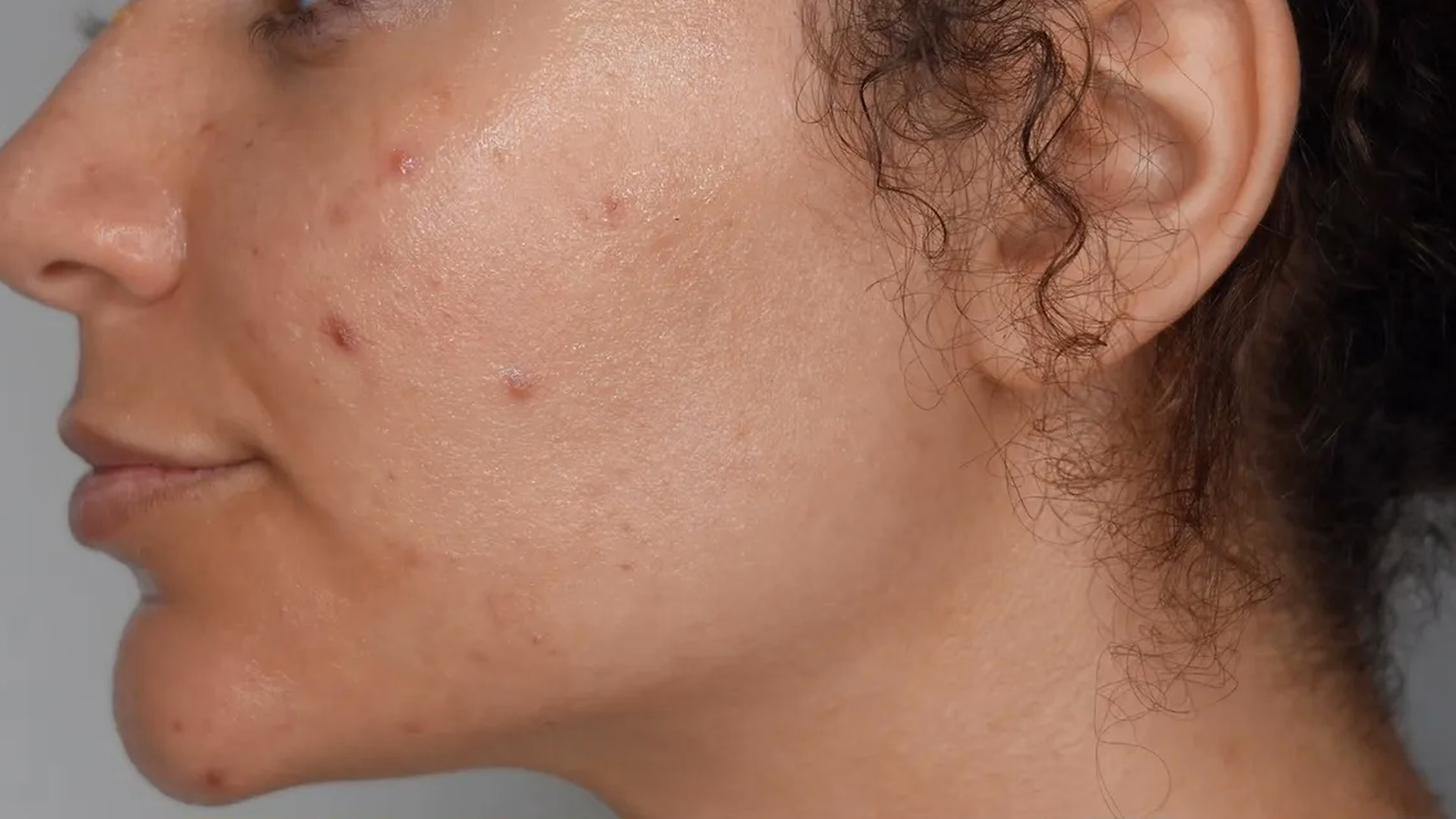 Skin rejuvenation before treatment at VIV Wellness Dallas