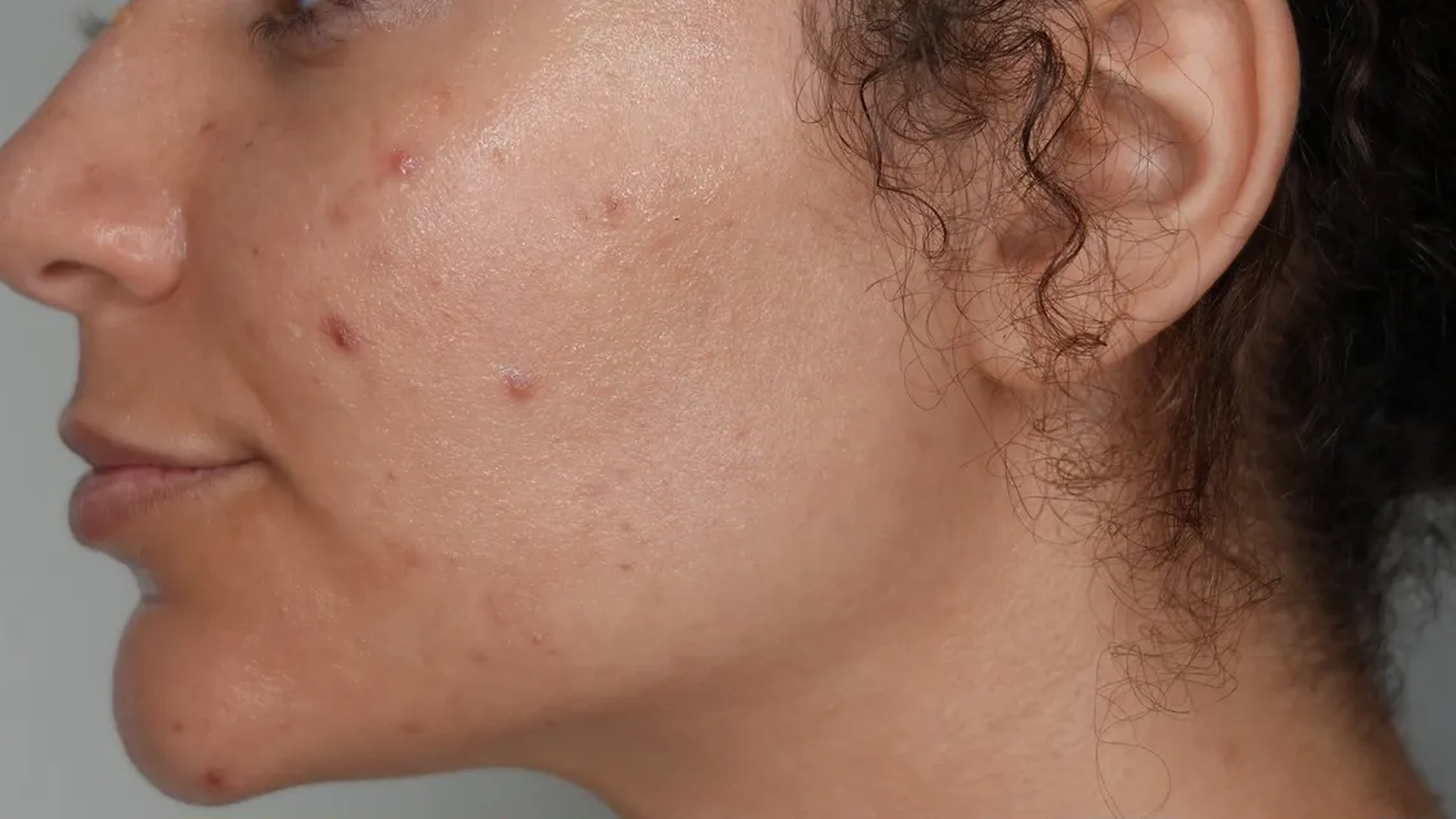Skin rejuvenation before treatment at VIV Wellness Dallas