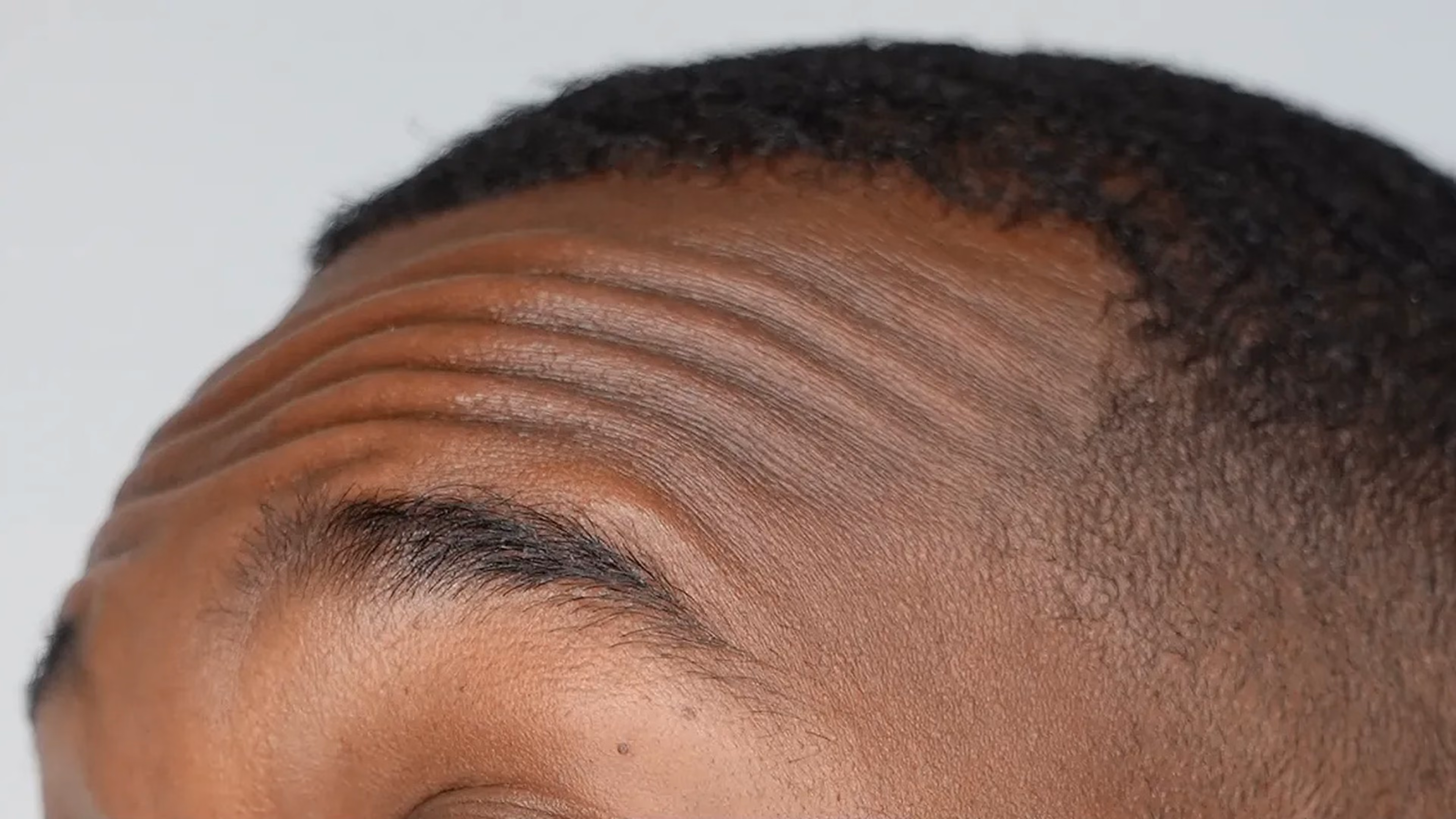 Wrinkle treatment before at VIV Wellness Dallas