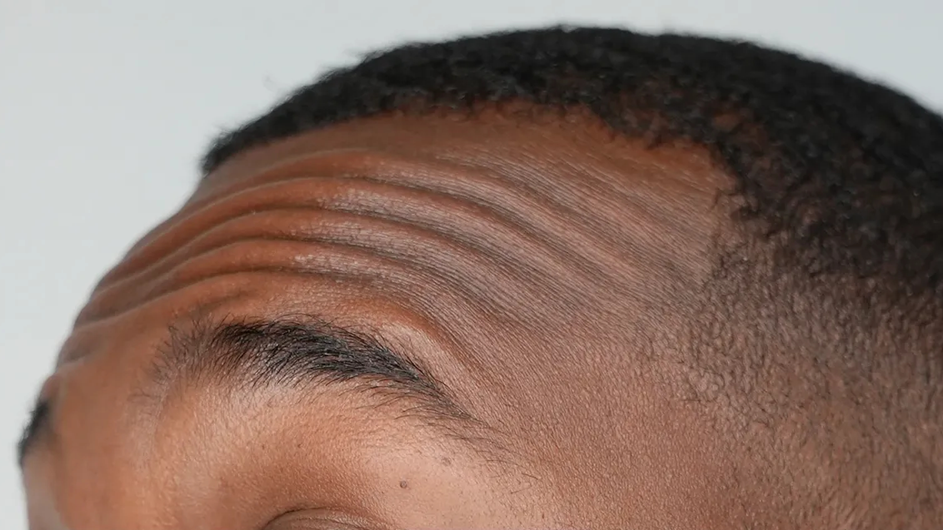 Wrinkle treatment before at VIV Wellness Dallas
