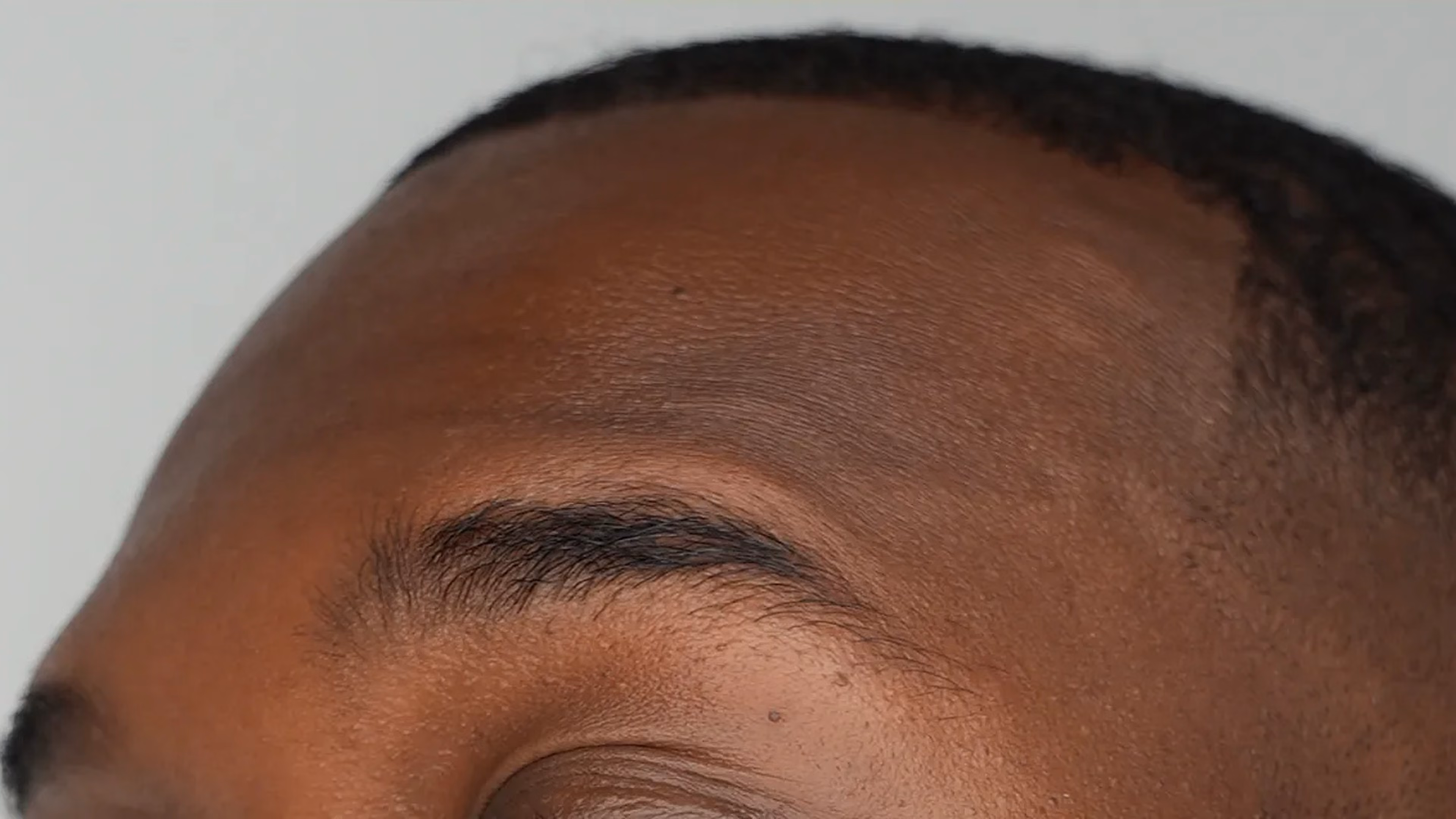 Wrinkle treatment after at VIV Wellness Dallas