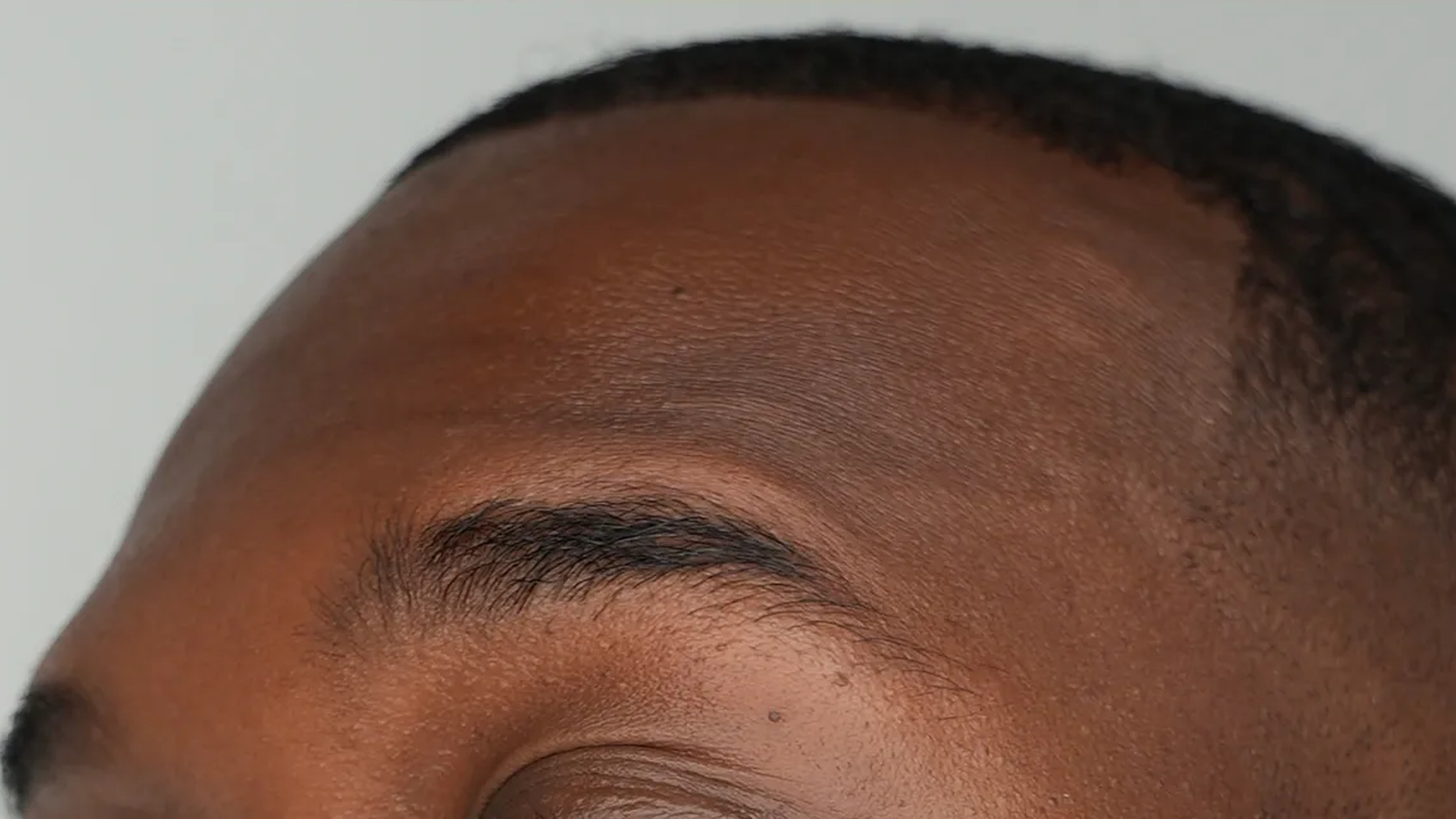 Wrinkle treatment after at VIV Wellness Dallas